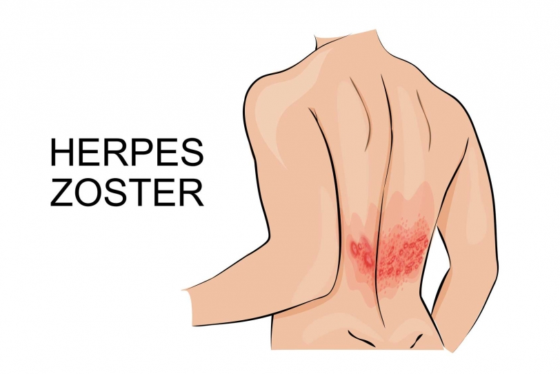 Salvador Bellver nos previene sobre el herpes zoster