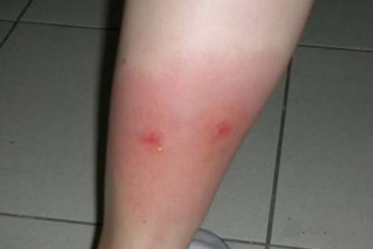 PP de Oliva: Una persona ingresada en el hospital por el mosquito tigre